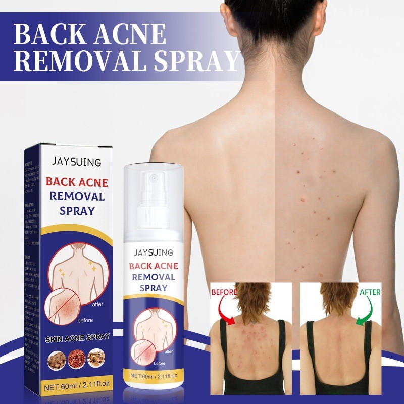 Jaysuing Back Care Spray สําหรับการทําให้บริสุทธิ์และรักษาสิวเฉพาะจุด Shopee Thailand