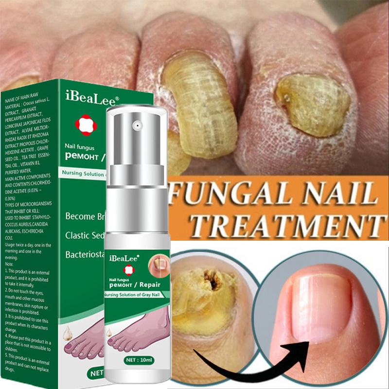 Nail Fungus Treatment Serum AntiInfection Onychomycosis Paronychia