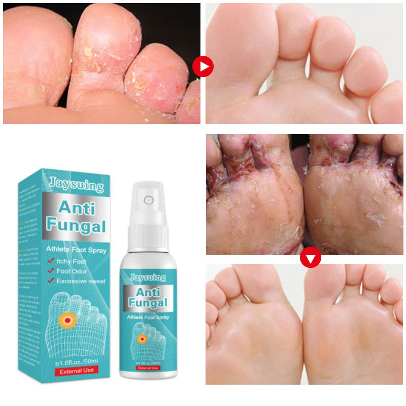 50G Herba Beriberi AntiItch Spray Antifungal Athlete 'S Foot Itching