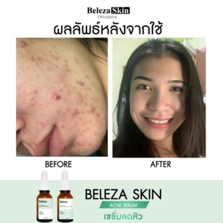 Beleza Skin Acne Serum&amp;Acne Spot Clear เซตคู่เซรั่มแก้แพ้ ลดสิวซ้ำซาก ฟื้นฟูผิวแพ้ง่าย สิวสเตียรอยด์ สิวฮอร์โมน 15 ml