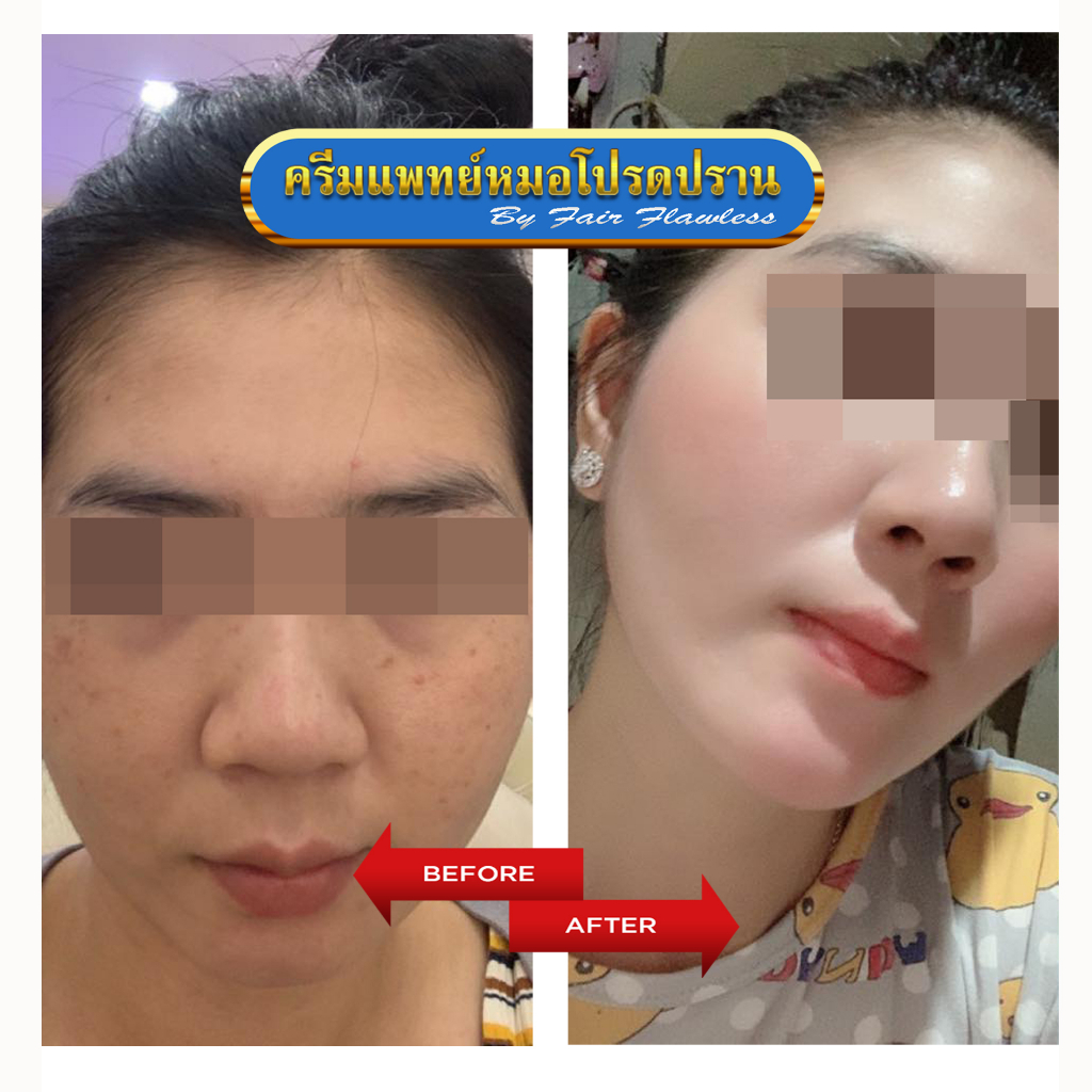 หน้าใส-ลดรอยสิว-20-pha-gel-ครีมแพทย์หมอโปรดปราน