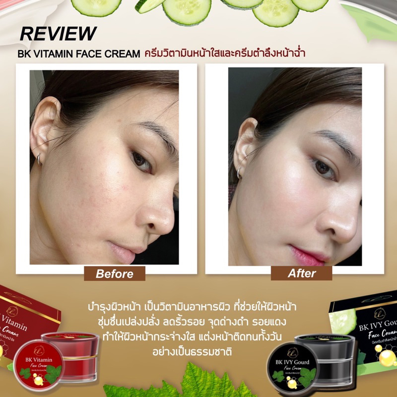 บีเคครีม-หน้าขาวใสรักษาสิวฝ้ากระ-ส่งฟรี