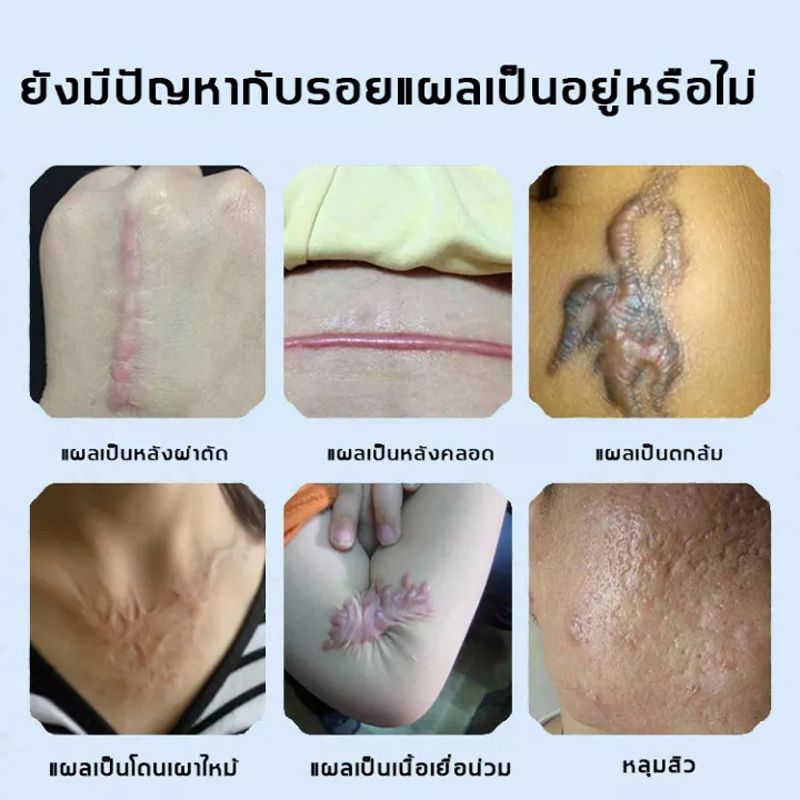 eelhoe-ครีมลดรอยแผลเป็น-ลบรอยแผลเปน-ครีมทาแผลเป็น-รักษารอยแผลเป็น-ทาแผลเป็น-ครีมแผลเป็น-ครีมลบแผลเป็น-ครีมแก้แผลเป็น