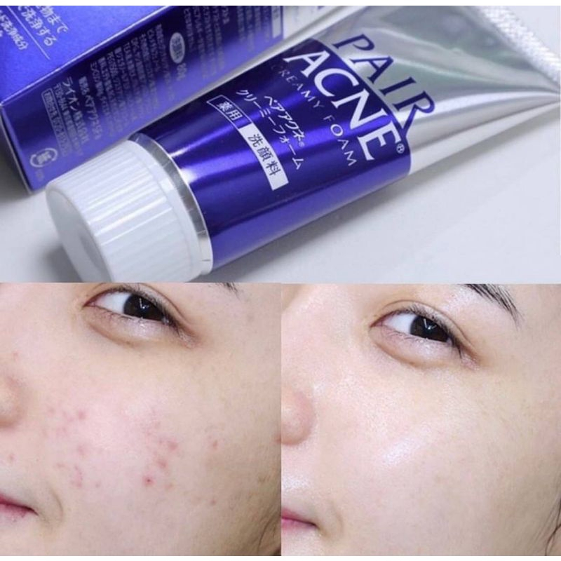 pair-acne-creamy-foam-ขนาด-80-g-ครีมโฟมล้างหน้าสูตรอ่อนโยน-ช่วยชำระล้างสิ่งสกปรก-ต้นเหตุของปัญหาสิวได้อย่างล้ำลึก