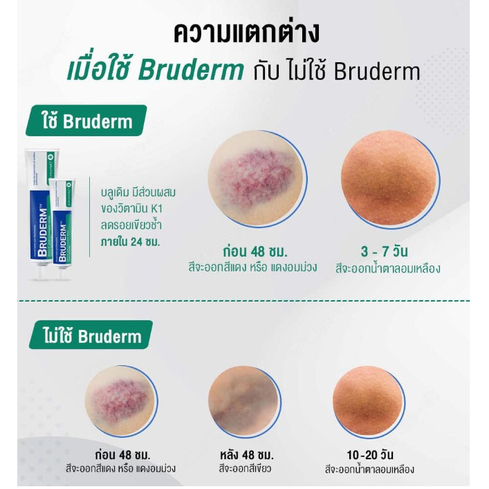 bruderm-10g-exp-2025-ครีมลดรอยช้ำ-ลดบวม-รอยแดง-ฟกช้ำ-หลังการทำศัลยกรรม-อันดับ-1-ที่มแพทย์ศัลยกรรมเกาหลีเลือกใช้