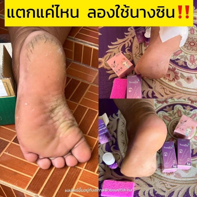 ส่งฟรี-สปาเท้าแตกนางซิน-บริการเก็บปลายทางฟรี