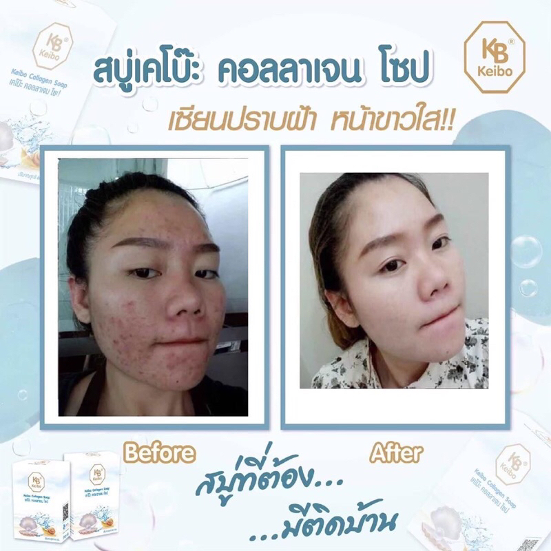 สบู่ฟ้ากระชากฝ้า-ขนาด-60-กรัม-พร้อมส่ง-ฝ้าที่ฝังลึกเป็นมานาน-หลุมสิวตื้นขึ้นชัดเจน