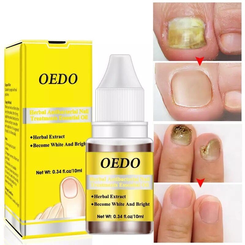 oedo-fda-รักษาเชื้อราเล็บ-ยาทาเชื้อราเล็บ-เชื้อราที่เล็บ-รักษาเล็บ-เชื้อราที่เล็บ-รักษาเล็บขบ-ฆ่าเชื้อราที่เล็บ10ml-พร้อ