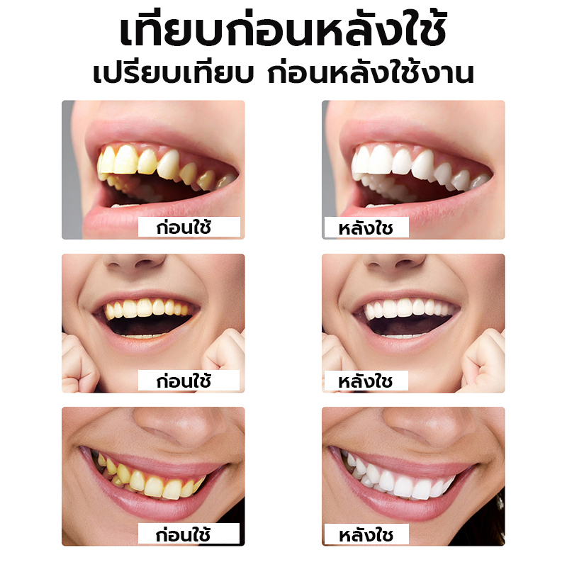 eelhoe-น้ำยาฟอกสีฟัน-10mlสุขอนามัยช่องปาก-ฟันเหลือง-ลดกลิ่นปาก-แปรงฟัน-น้ำยาฟอกสีฟัน-ฟอกฟันขาว-ฟันเหลือง-เซรั่มฟอกฟันขาว