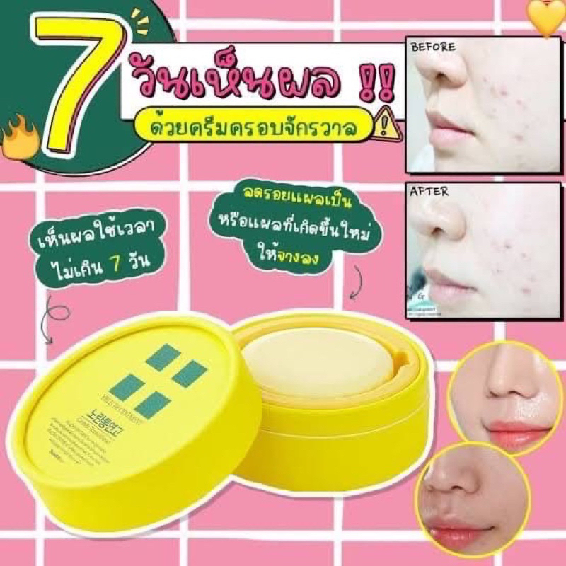 ครีมลดรอยสิว-รอยแผลเป็น-ที่รพ-ศัลยกรรมดังๆในเกาหลีเลือกใช้-yellow-ointment-centella-treated-extract-ขนาด-18g