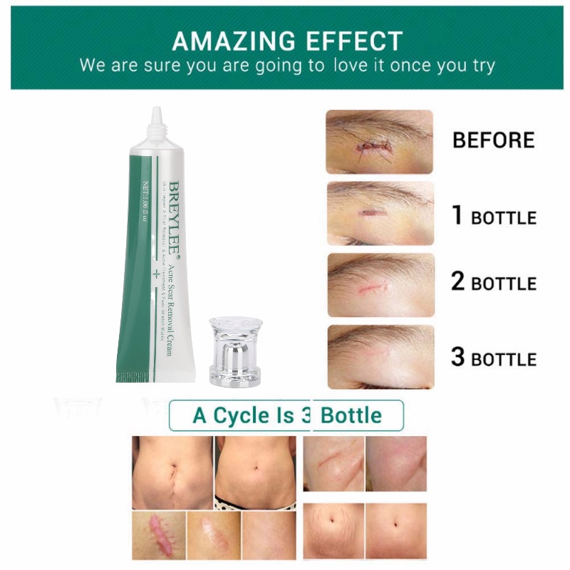 breylee-scar-removal-gel-30g-ครีมลดรอยแผลเป็น-ลดผิวแตกลาย-ลบรอยแผลเป็น-ลดเลือนป้องกันรอยแผลเป็น