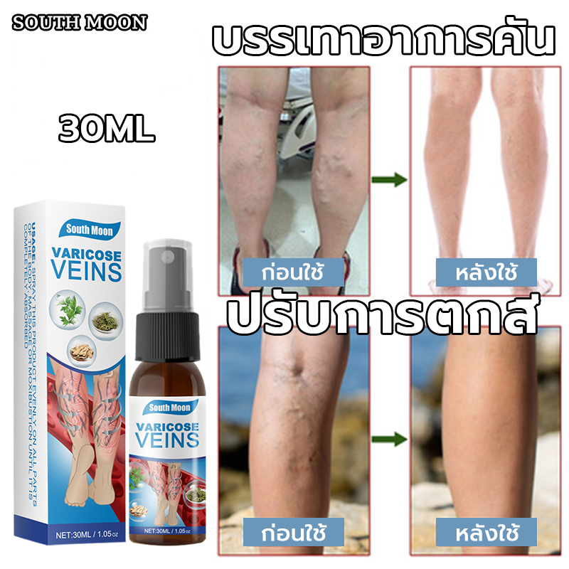 south-moon-สเปรย์เส้นเลือดขอด-30ml-บอกลาเส้นเลือดขอดเส้นเลือดดำอุดตันและอาการป-เส้นเลือดขอด-เส้นเลือดขาบวม