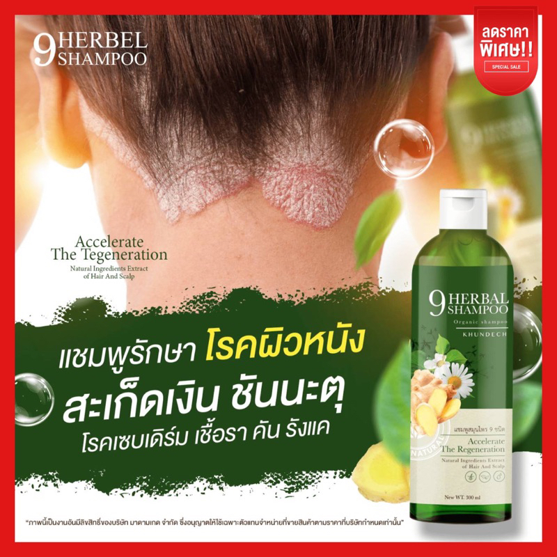 ส่งฟรี-2-แถม-1-แชมพูรักษาโรคผิวหนัง-แชมพูขุนเดช-รักษารังแค-โรคผิวหนัง-เชื้อรา-สะเก็ดเงิน-หนังหัวลอก-จบในขวดเดียว