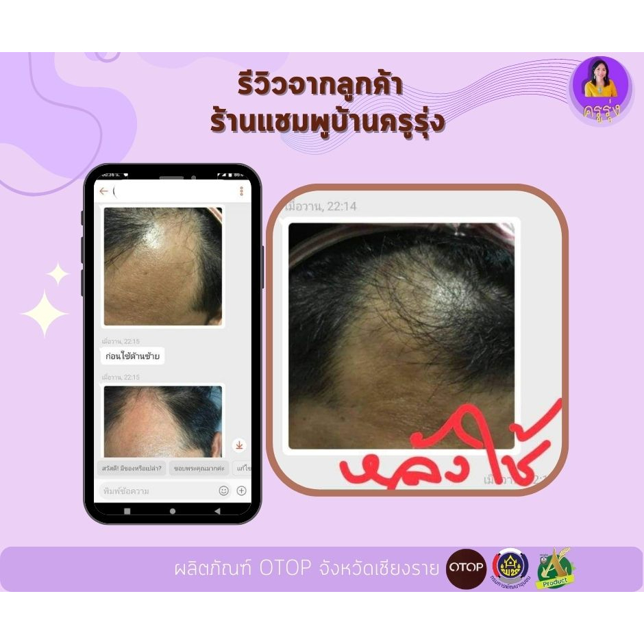 เซรั่มปลูกผม-เซรั่ม-สมุนไพร-ดอกอัญชัน-serum-50ml-1-ขวด-เซรั่มเร่งผมยาว-แก้ปัญหาหัวล้าน-ลดผมบาง-ลดผมร่วง-banorganic