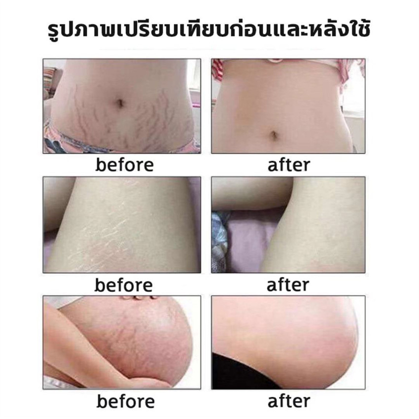 aichunครีมกันแตกลาย-ครีมลดรอยแตกลาย-ครีมทาท้อง-ครีมทาท้องลาย60กรัม-แก้แตกลาย-ครีมแก้ท้องแตกลาย-ครีมแก้ท้องลาย-ลดผิวแตกลา