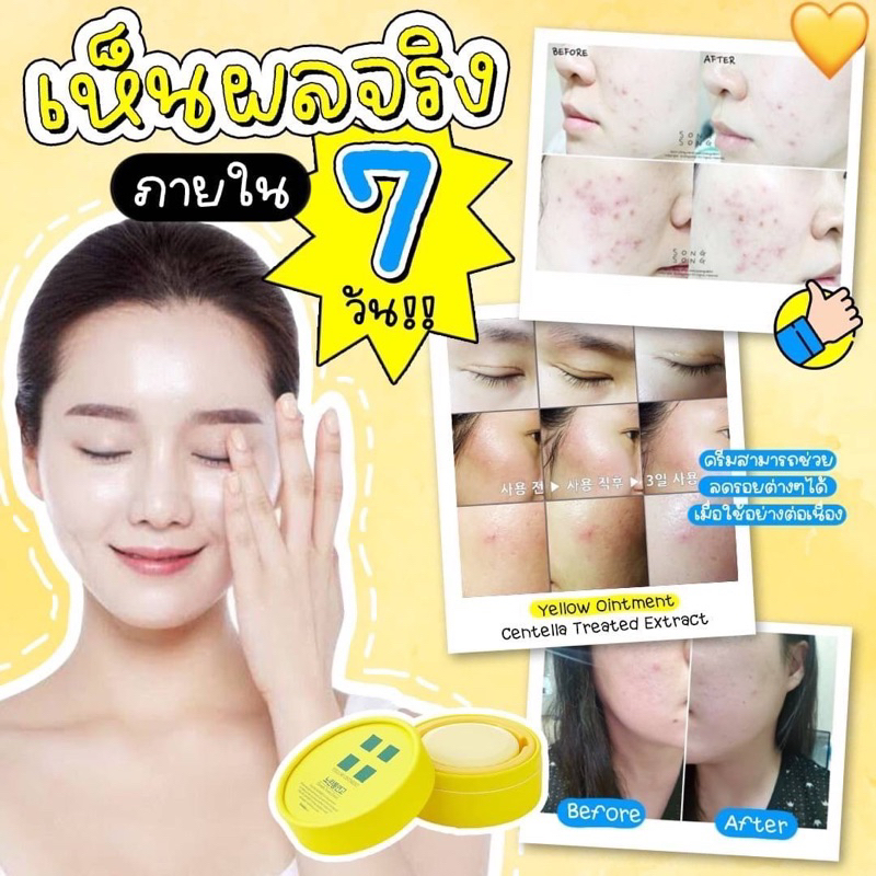 ครีมลดรอยสิว-รอยแผลเป็น-ที่รพ-ศัลยกรรมดังๆในเกาหลีเลือกใช้-yellow-ointment-centella-treated-extract-ขนาด-18g