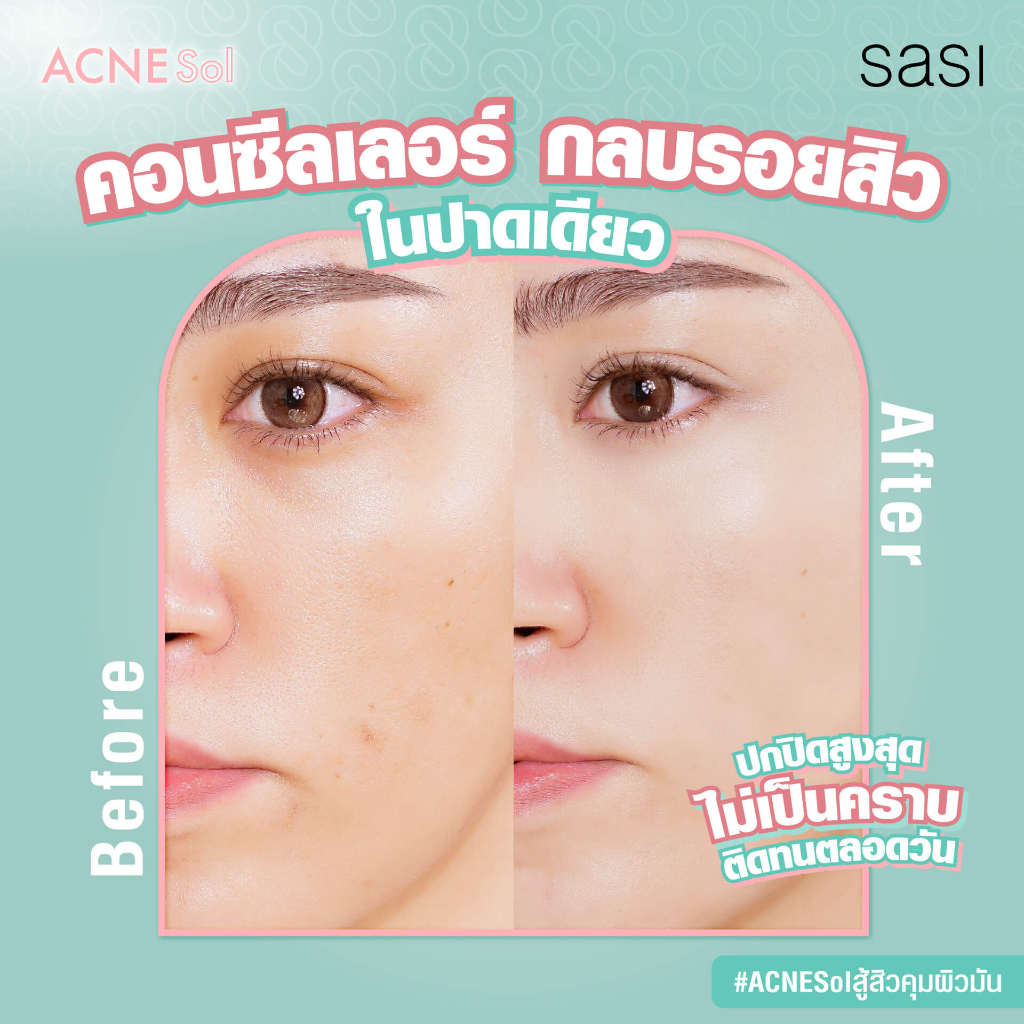 1ซอง-sasi-acne-sol-comfort-matte-concealer-2ml-n1-5-natural-beige-ศศิ-คอนซีลเลอร์