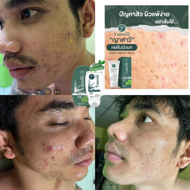 เจลใบบัวบก-ญาตาวี-ลดสิว