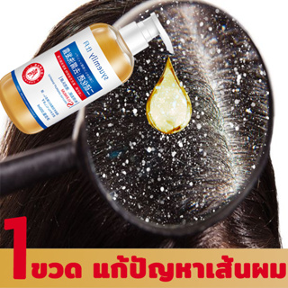 shiyue แชมพูลดสิว 300ML รังแค หนังศีรษะมัน ขจัดรังแค กลาดเกลื่อน เชื้อรา ช่วยบำรุงเส้นผมและหนังศรีษะ แชมพูลดอาการคัน