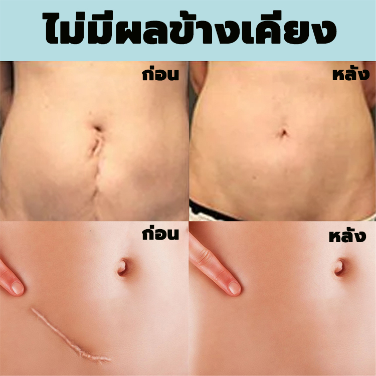 eelhoe-ครีมลดรอยแผลเป็น-50ml-ลบรอยสิว-รอยแผลเป็น-จุดด่างดำ-หมองคล้ำ-ลดผิวแตกลาย-ลบรอยแผลเป็น-scar-gel