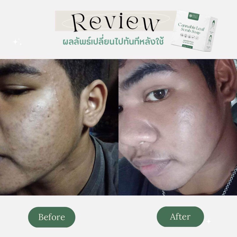 สบู่firstwhite-ลดสิวลดรอย