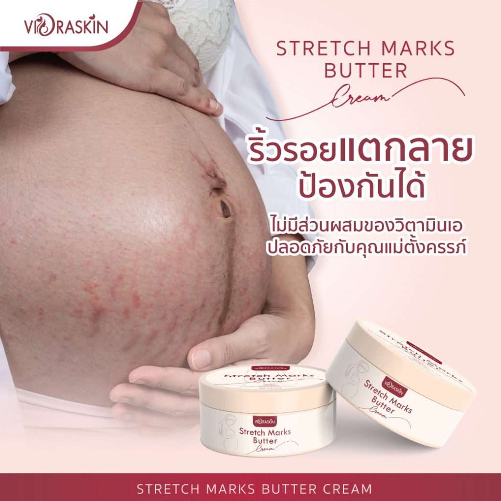 stretch-marks-butter-cream