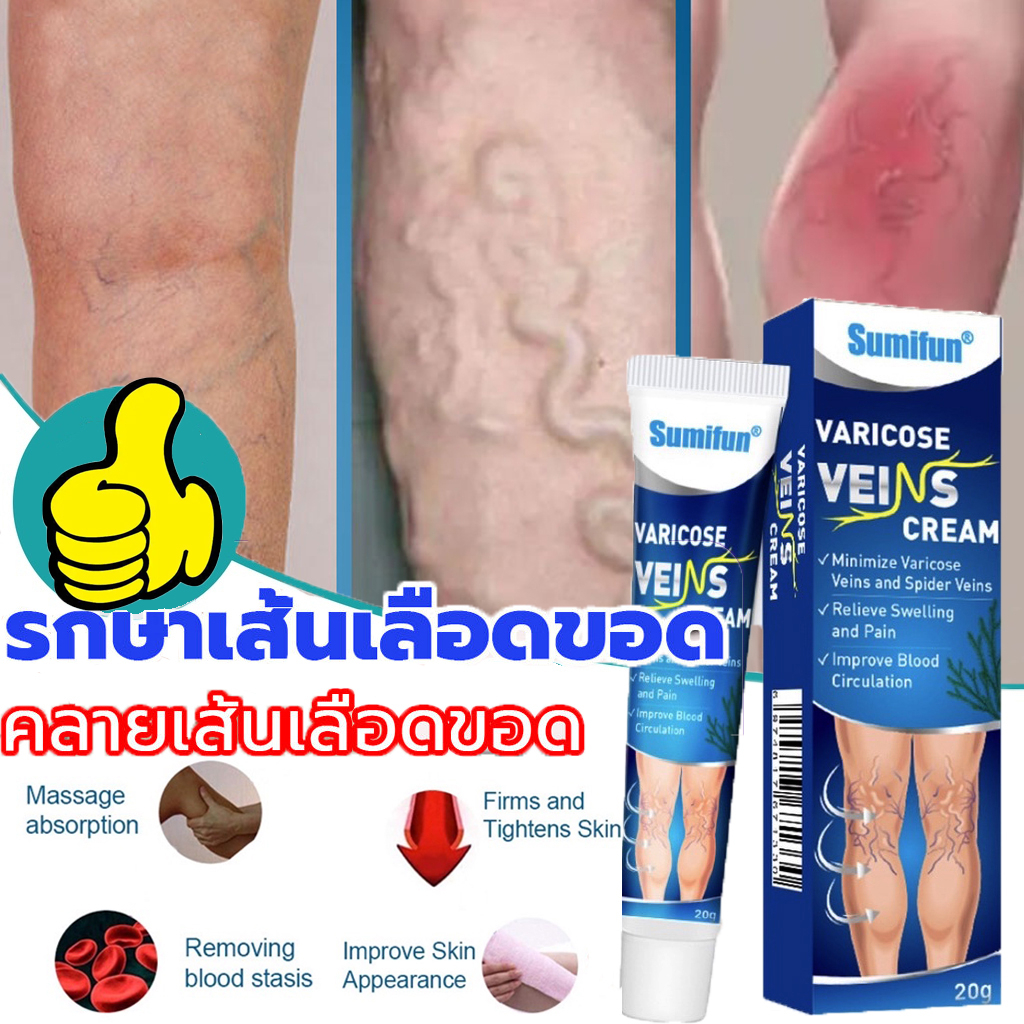 ของแท้100-ครีมสมุนไพรรักษาเส้นเลือดขอด-1หลอด20กรัม-ครีมเส้นเลือดขอด-รักษาเส้นเลือดขอด