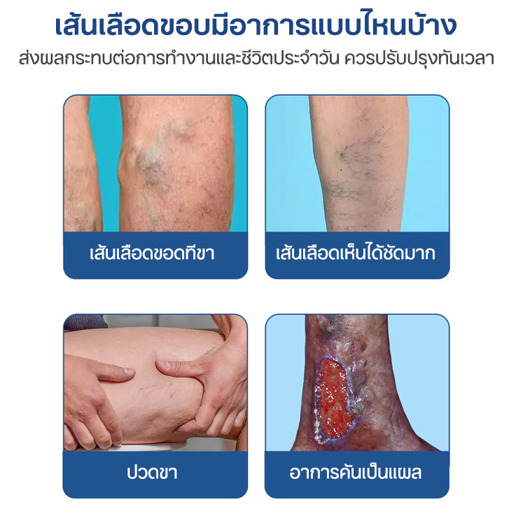 authentic-blood-heel-varicose-veins-varicose-veins-cream-say-goodbye-to-varicose-veins-the-veins-are-clogged-and-painful-ส้นเลือดขอด-ยาทาเส้นเลือดขอด-ครีมทาเส้นเลือดขอด-บอกลาเส้นเลือดขอด-เส้นเลือดดำอุ