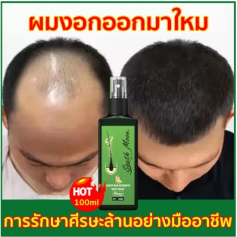 บอกลาหัวล้าน-ปลูกผมหนา-ช่วยลดผมร่วง-สเปรย์ปลูกผม-ยาปลูกผม-ป้องกันผมร่วงน้ำยาเร่งผมยาว-น้ำยาปลูกผม-เร่งผมยาวไว-แก้ปัญหา