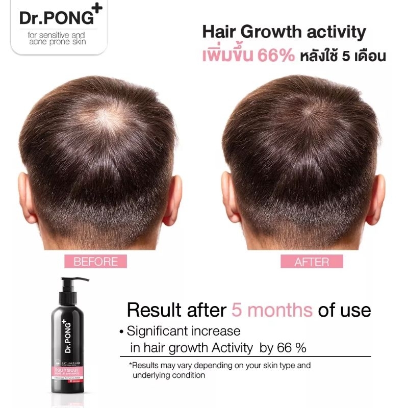 dr-pong-anti-hair-loss-exp-04-25แชมพูลดผมร่วง