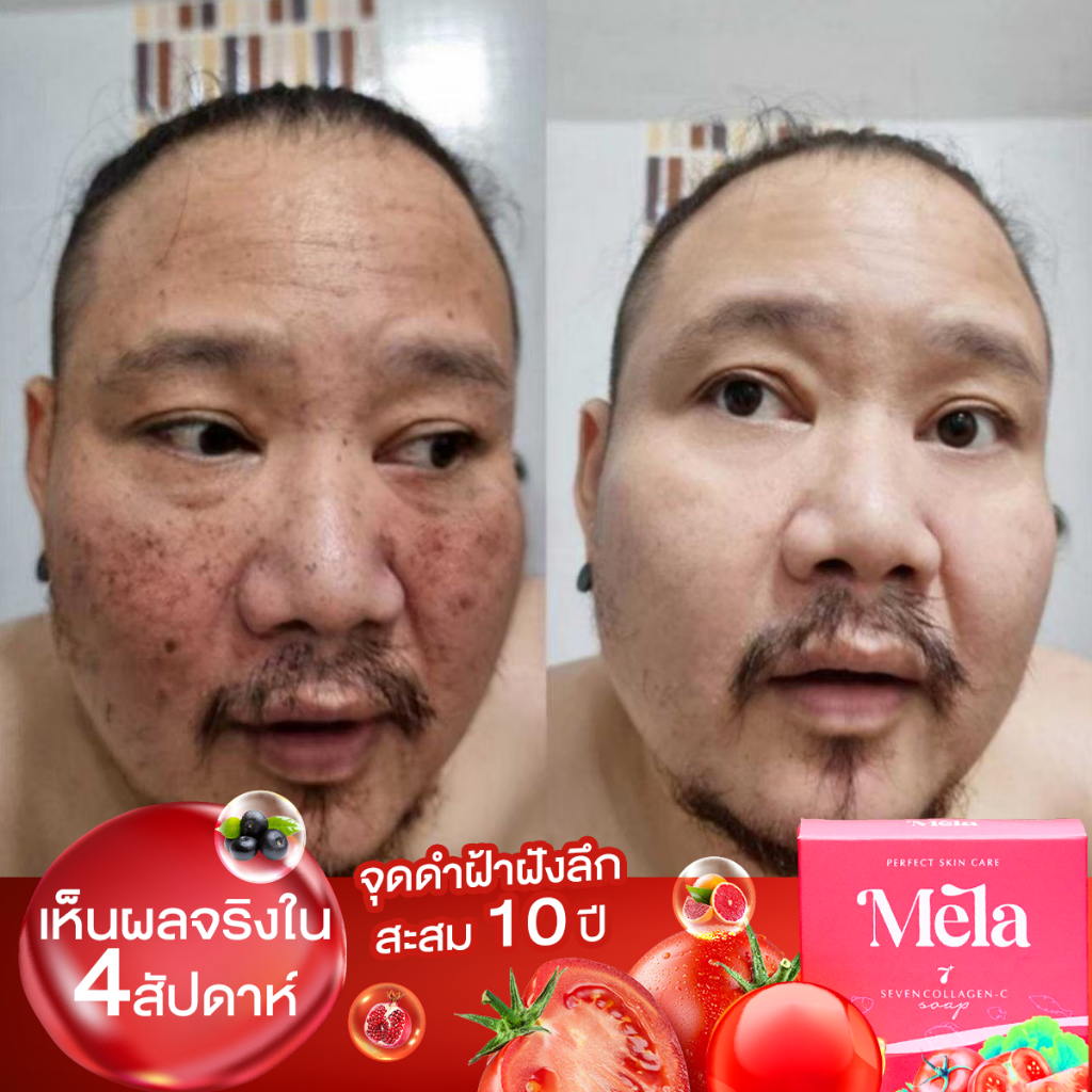 5-ก้อน-สบู่ล้างฝ้าสบู่-mela-ฝ้าจางลดรอยสิว-สบู่หน้าเงา-หน้าเนียน-ลบฝ้ากระ-จุดด่างดำ-หน้าขาว-สบู่