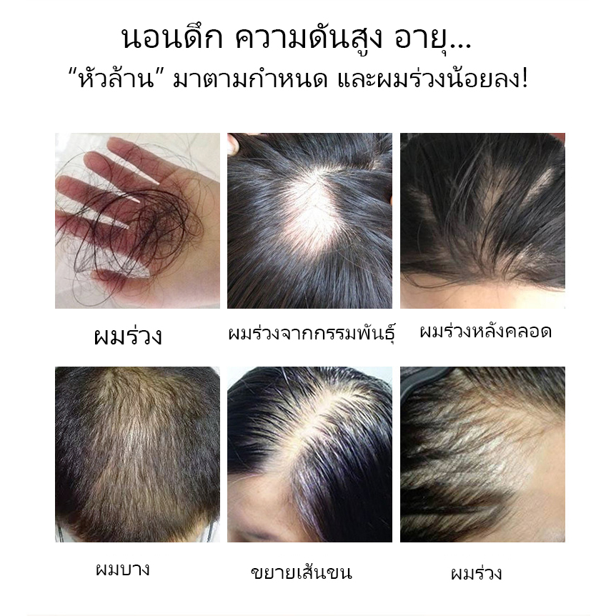 เซรั่มปลูกผม-น้ำยาเร่งผมยาว-เซรั่มขิง-ปลูกผม-30ml-น้ำยาปลูกผม-เซรั่มปลูกผม-ป้องกันผมร่วง-บอกลางความบาง-บำรุงผม-ผมดกกำ