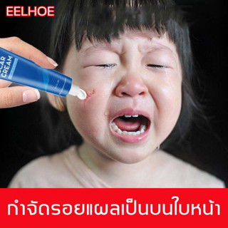 EEIHOE ครีมลดรอยแผลเป็น ครีมลบแผลเป็น ลบรอยแผลเปน สำหรับรอยสิว แผลเผาไหม้ แผลเป็นจากการผ่าตัด ซ่อมแซมรอยแผลเป็นจากการผ่า