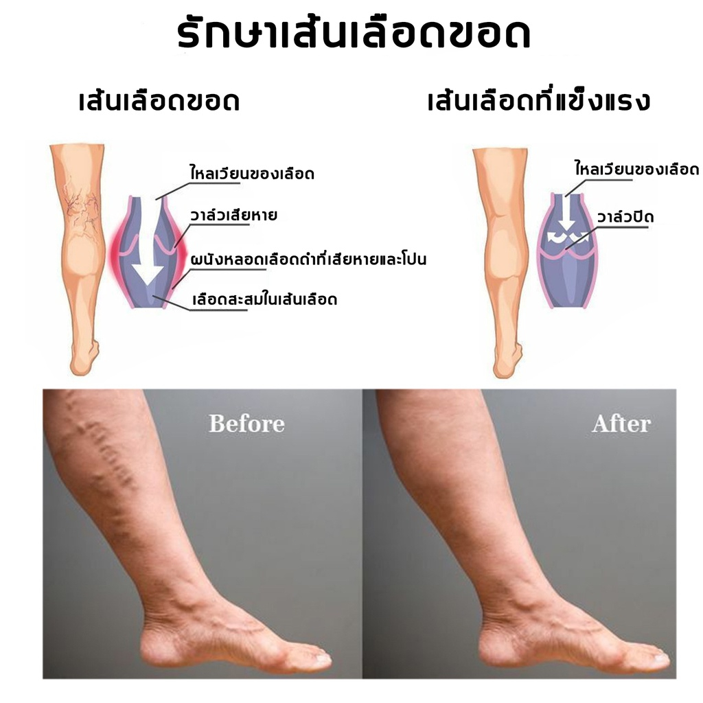 authentic-blood-heel-varicose-veins-varicose-veins-cream-say-goodbye-to-varicose-veins-the-veins-are-clogged-and-painful-ส้นเลือดขอด-ยาทาเส้นเลือดขอด-ครีมทาเส้นเลือดขอด-บอกลาเส้นเลือดขอด-เส้นเลือดดำอุ