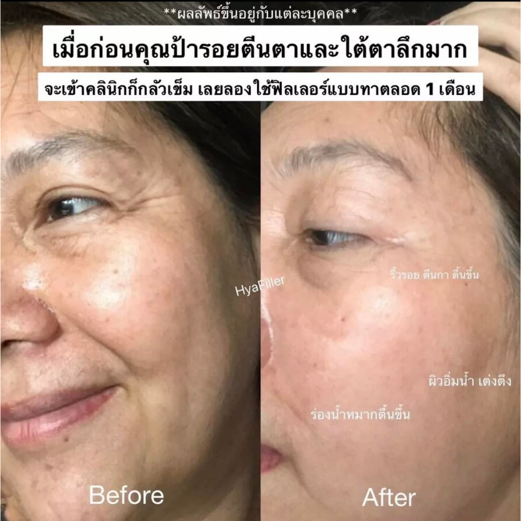 filler-ampoule-double-serum-mara-ฟิลเลอร์ที่ไม่ต้องฉีด-แต่เป็น-แบบทา-เซรั่มไฮยา-ลดริ้วรอย-ตีนกา-ร่องลึก