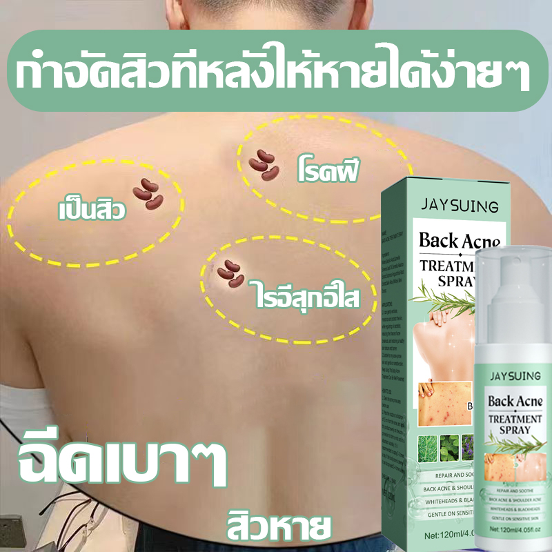 กําจัดสิวได้อย่างรวดเร็วโดยไม่ทิ้งร่องรอย-jaysuing-สเปรย์รักษาสิวที่หลัง-สิวหน้าอก-สิวใบหน้า-สูตรแพทย์แผนไทย