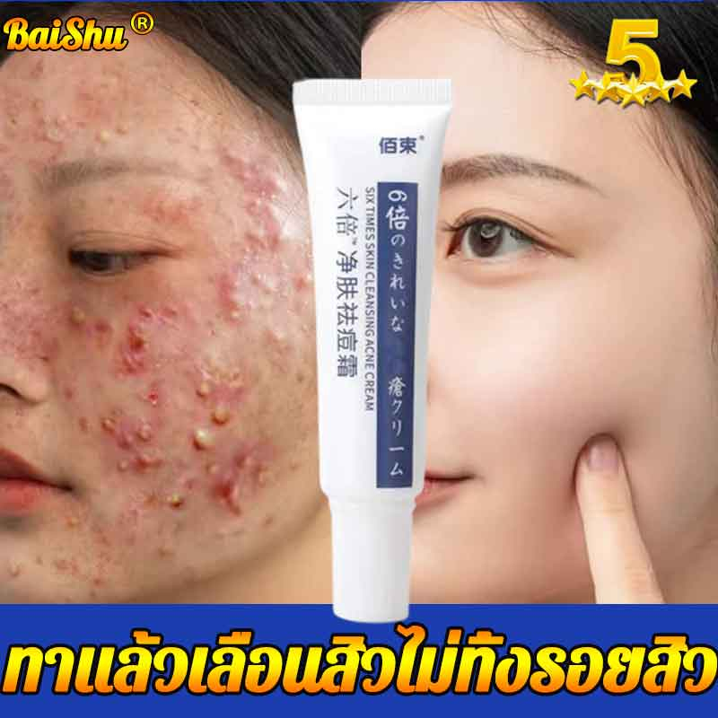 ครีมลดสิว-สิวอักเสบ-มีประสิทธิภาพและเร็ว-ไม่เป็นซ้ำ-อ่อนโยน-ปลอบประโลมและซ่อมแซม-สิว-สิว-กำจัดสิว-ครีมกำจัดสิว-ครีมลดสิ