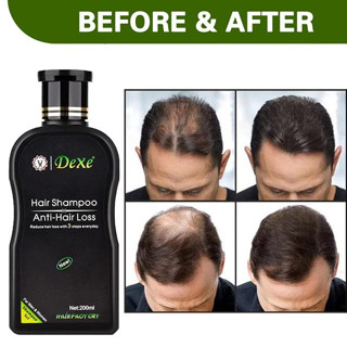 Dexe hair shampoo แชมพูบำรุงหนังศรีษะลดการขาดล่วง แชมพู สระผม ลดปัญหาผมร่วง ผมบาง ลดอาการคัน ขจัดรังแค