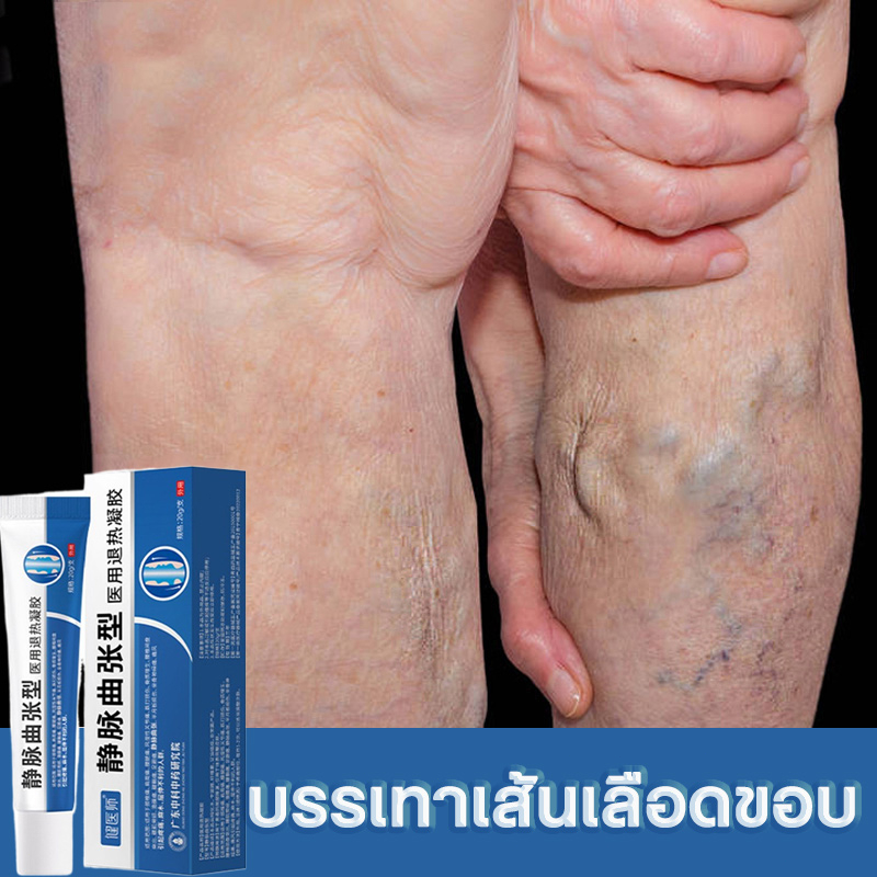 authentic-blood-heel-varicose-veins-varicose-veins-cream-say-goodbye-to-varicose-veins-the-veins-are-clogged-and-painful-ส้นเลือดขอด-ยาทาเส้นเลือดขอด-ครีมทาเส้นเลือดขอด-บอกลาเส้นเลือดขอด-เส้นเลือดดำอุ