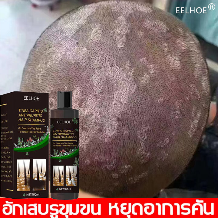 ยาขจัดรังแค100ml-ยาสระผมแก้เชื้อรา-ยาขจัดรังแค-ยาสระผมรังแค-คันศีรษะ-ยาสระผมเชื้อรา-แชมพูรักษารังแค-shampoo