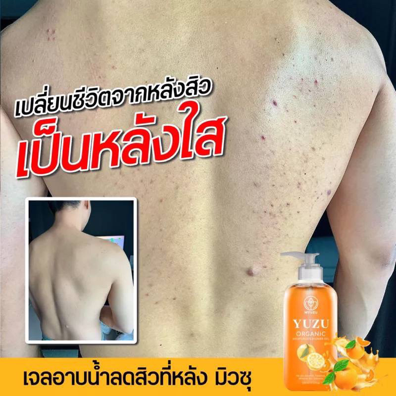 เซ็ตขายดีx2ขวด-เจลอาบน้ำมิวซุ-organic-มี-biosol-ช่วยฆ่าเชื้อสิว-ลดรอยดำ-ผดผื่น-สิวหลัง-สิวหน้าอก-ลดสิวที่หลัง