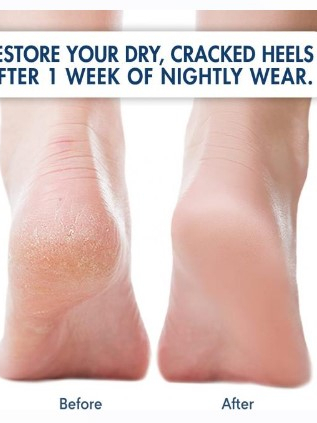 moisturizing-heel-sock-ถุงเท้าบำรุงแก้ส้นเท้าแตก-ถุงเท้าบำรุงส้นเท้า-ที่แตกแห้งกร้าน