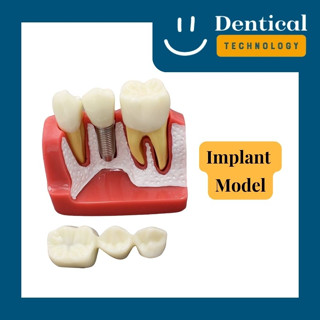 โมเดลงานทันตกรรมติดแน่น รากเทียม-ครอบ-สะพานฟัน สำหรับอธิบายผู้ป่วย (Implant Model)