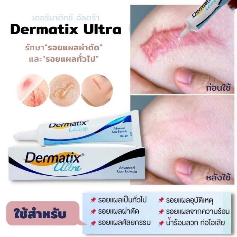 พร้อมส่งจากไทย-ของแท้-dermatix-ultra-gel-15g-เดอร์มาติกซ์-อัลตร้า-เจล-15-กรัม-จัดส่งทันที-ครีมลดรอยแผลเป็น-ครีมลบรอยแผลเป็น-ครีมรักษาแผลเป็น-ซ่อมแซมผิวที่เสียหาย