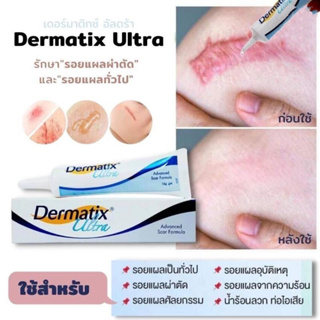 【พร้อมส่งจากไทย】 ของแท้ Dermatix Ultra Gel 15g เดอร์มาติกซ์ อัลตร้า เจล 15 กรัม จัดส่งทันที ครีมลดรอยแผลเป็น ครีมลบรอยแผลเป็น ครีมรักษาแผลเป็น ซ่อมแซมผิวที่เสียหาย