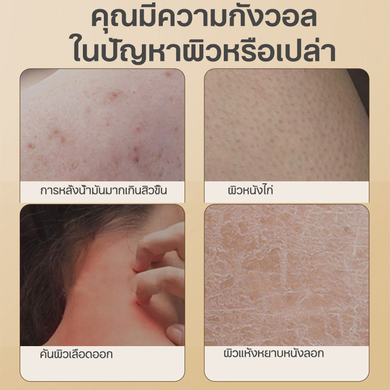 ลดสิวที่หลัง-สบู่ผิวขาว-ครีมอาบน้ําผิวขาว-ครีมอาบน้ำหอมๆ-ครีมอาบน้ำ-ช่วยฆ่าเชื้อสิว-ลดรอยดำ-ผดผื่น-สิวหลัง-สิวหน้าอก