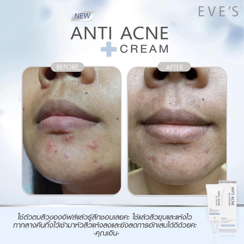 eves-anti-acne-cream-ครีมแต้มสิวอีฟส์-สิวยุบไว-สิวแห้งไว