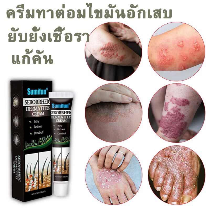 ครีมทา-กลากเกลื้อน-ลดอาการคัน-โรคผิวหนัง-ครีมต้านเชื้อแบคทีเรีย-เชื้อรา-กลาก-เกลื้อน-ผิวหนังอักเสบ-ลดอาการผื่น-พกพาสะดวก