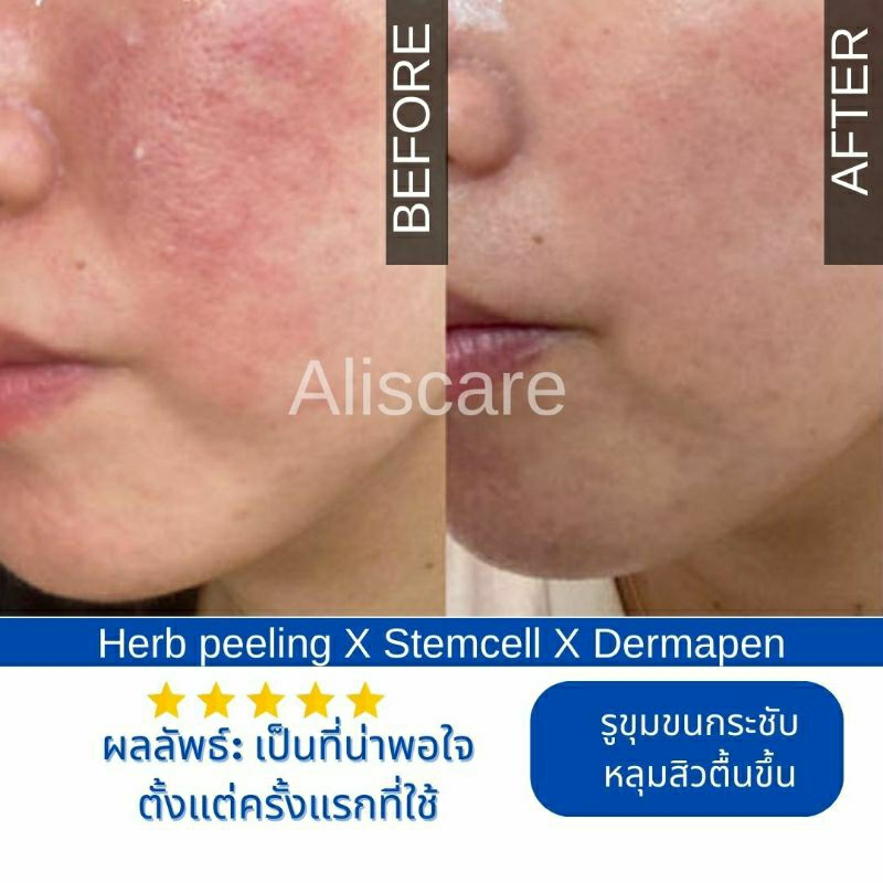 พร้อมส่ง-microneedling-injection-ผลัดเซลล์ผิวเสีย-กระชับรูขุมขน-หลุมสิวเรียบเนียนกระจ่างใส