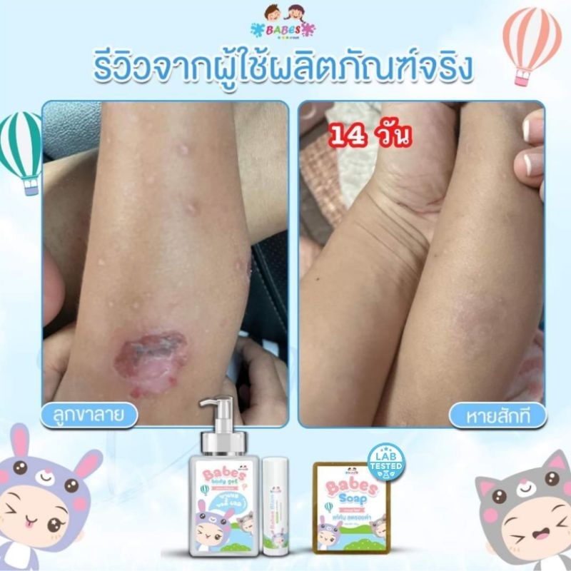 babes-soap-บาเบส-โซฟ-สบู่แก้คัน-ขาลาย-แพ้ยุง